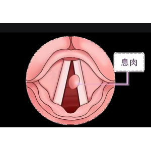 聲音嘶啞、嗓子難受，聲帶息肉不可小覷