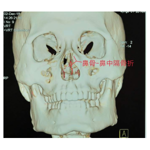 貴陽銘仁耳鼻喉醫(yī)院提醒您：鼻子很脆弱，要好好保護