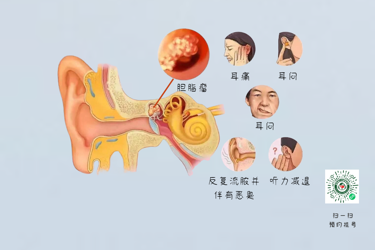 手術(shù)沒做干凈，術(shù)后3年顱內(nèi)竟發(fā)現(xiàn)巨大膽脂瘤！(圖6)