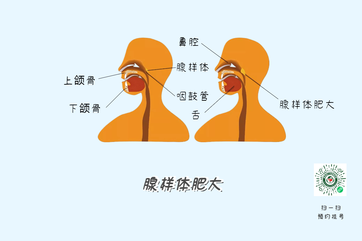 暑假來了，孩子腺樣體肥大到底切不切？(圖4)