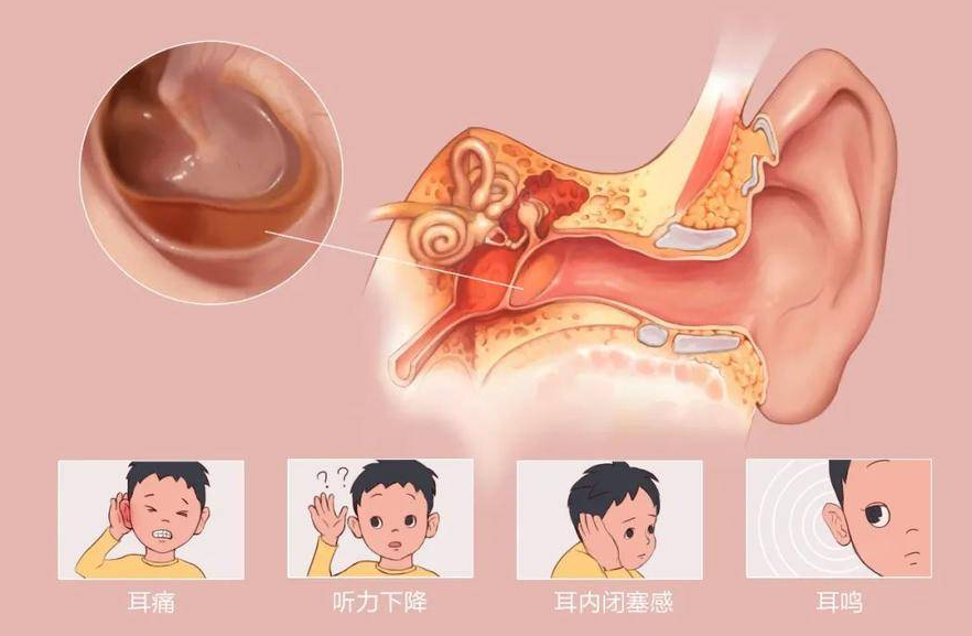  夏季游泳，謹(jǐn)防中耳炎“找麻煩”！(圖3)