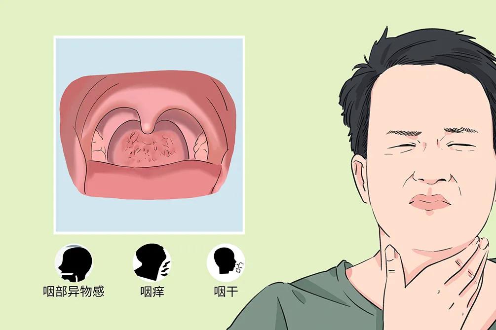 慢性咽炎的困擾：咽干、咽痛、咽部異物感(圖2)