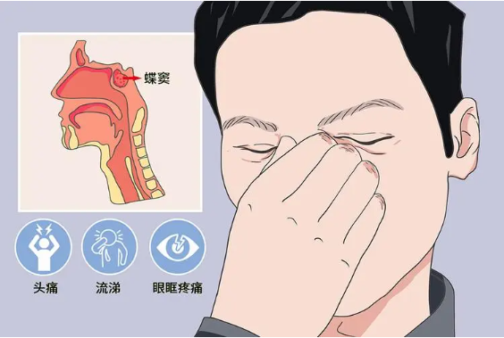 頭疼、眼痛雖小，卻可能是蝶竇炎發(fā)出的警告信號！(圖1)