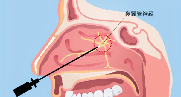 頭疼、眼痛雖小，卻可能是蝶竇炎發(fā)出的警告信號！(圖2)