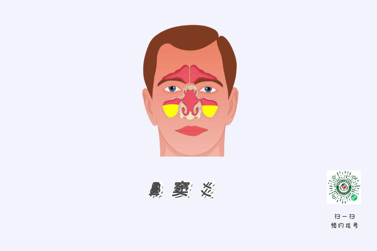鼻竇炎頭痛有特點(diǎn)！這個(gè)位置痛要當(dāng)心(圖1)
